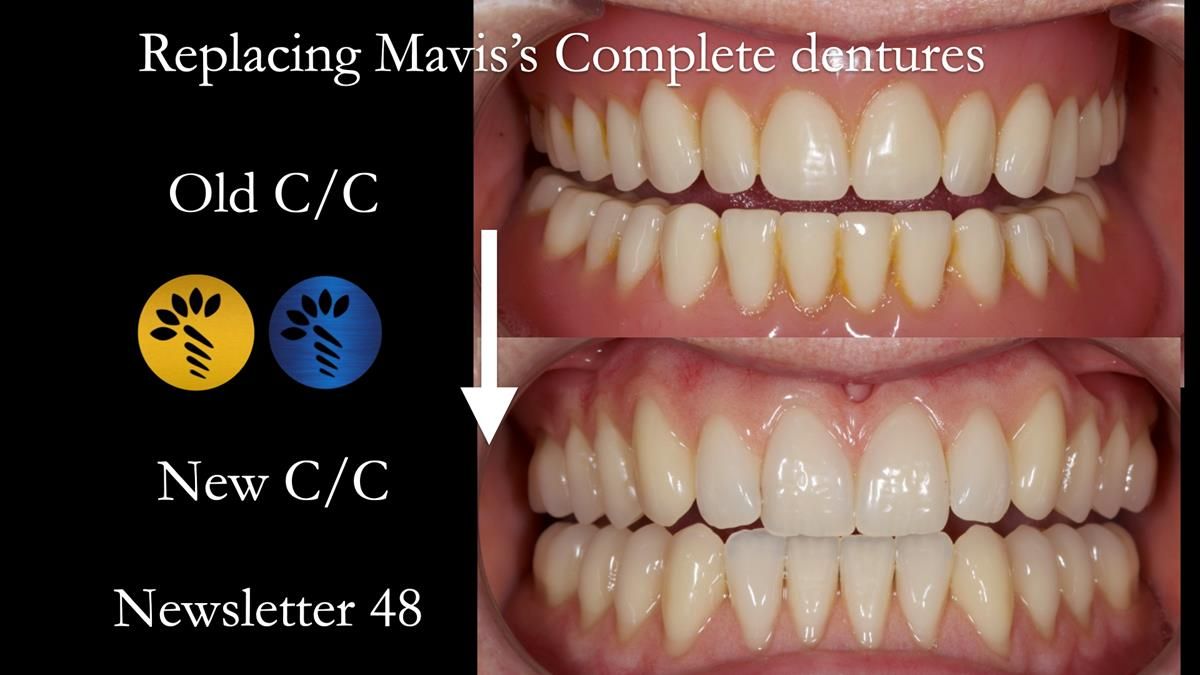 Full protocol - case presentation of Mavis's complete denture provision