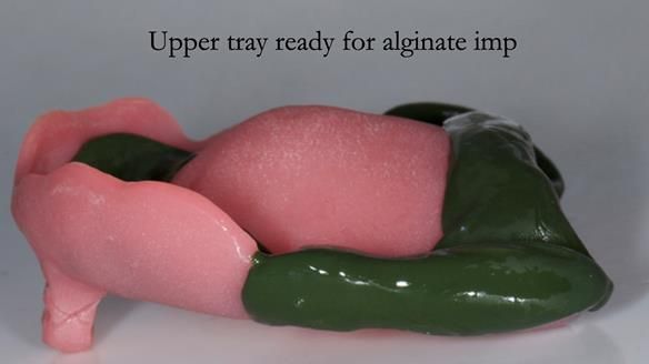 Complete denture Class II div 2 deep overbite Newsletter 39