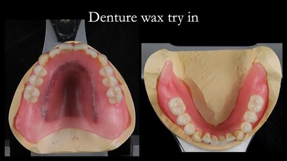 Newsletter 50 Special edition Complete Dentures FULL PROTOCOL