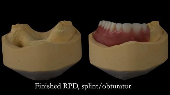 Upper metal base partial denture/occlusal stabilisation splint/obturator - full protocol