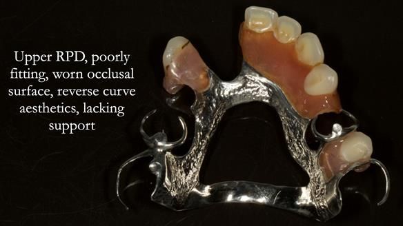 Eileen's transformation with upper and lower RPDs of Scandinavian hygienic design FULL PROTOCOL
