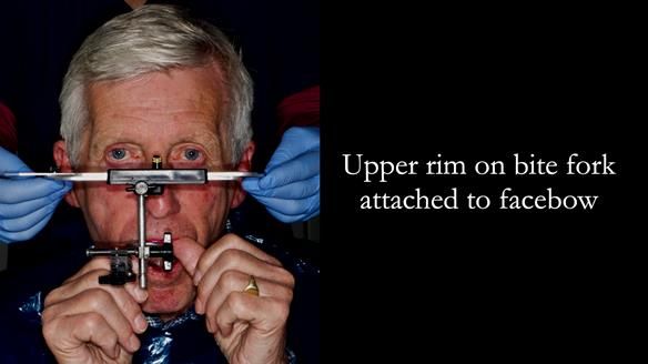 Newsletter 77: Jeremy’s case – immediate complete upper denture