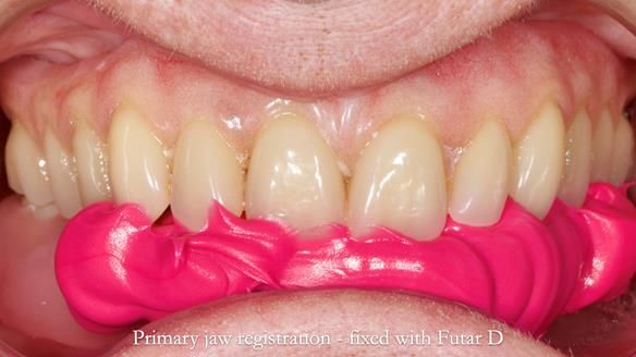 Newsletter 82 Mary - A complete upper and a one-tooth gasket denture