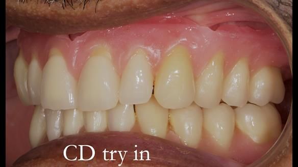 Finlay's Newsletter 62 provision of extractions and metal based complete dentures for Rafique