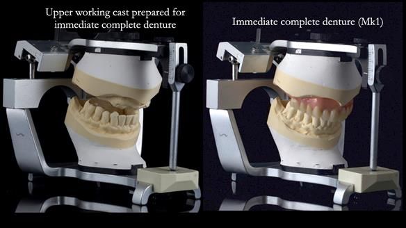 Newsletter 77: Jeremy’s case – immediate complete upper denture