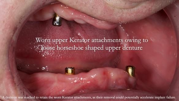 Newsletter 57 showcases the making and fitting process of implant-supported complete dentures for Alisdair