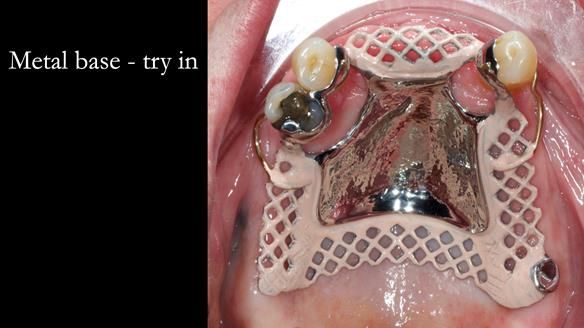 Finlay's Newsletter 59 Ultra hard partial dentures made for Gill