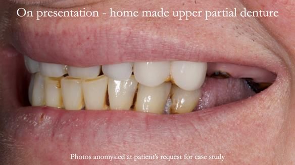 Newsletter 52 Managing Jo’s failing dentition with extractions and Mk 1/Mk 2 complete upper dentures and lower partial dentures FULL PROTOCOL