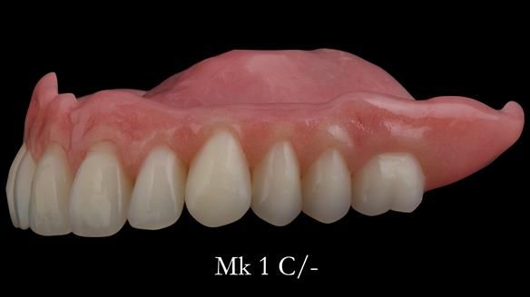 Newsletter 52 Managing Jo’s failing dentition with extractions and Mk 1/Mk 2 complete upper dentures and lower partial dentures FULL PROTOCOL