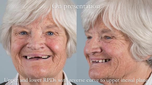 Eileen's transformation with upper and lower RPDs of Scandinavian hygienic design FULL PROTOCOL