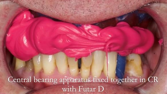 Newsletter 77: Jeremy’s case – immediate complete upper denture