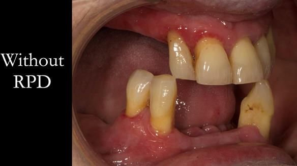 Finlay's Case Study Newsletter 40 - Immediate Mk 1 RPD to Definitive Mk 2 RPD - full protocol