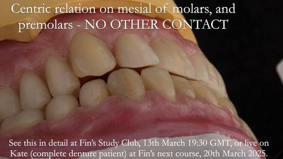 Newsletter 75: Marion’s case - Step-by-step complete denture workflow