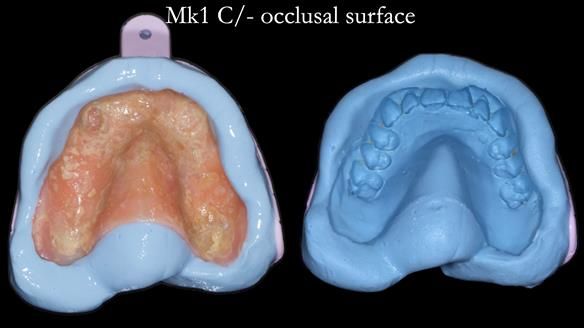 Newsletter 77: Jeremy’s case – immediate complete upper denture