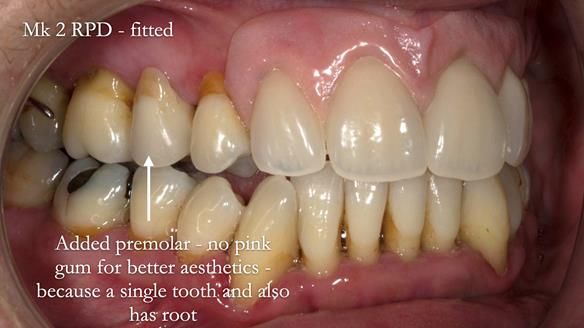 Finlay's Newsletter 63 Case study provision of metal based Scandinavian RPD - functional 10 years on