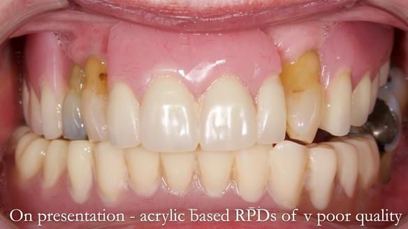 Finlay's Newsletter 59 Ultra hard partial dentures made for Gill