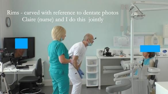 Visit 3 registration stage - prescribing the position of the upper teeth and the correct occlusal vertical dimension