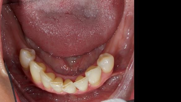 Newsletter 81 - Pam’s Story — how a partial denture changed her life (+ live walkthrough this Thursday)