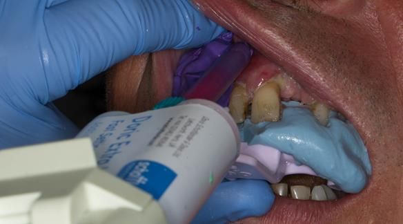 Figure 15 Stage 2 primary impression - Alginate reseated in the mouth Schottlander Doric Heavy bodied silicone used to record the depth sulcus