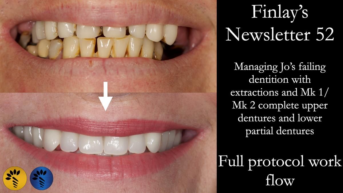 This newsletter describes the full protocol workflow of extractions and Mk 1 and Mk 2 complete upper denture and a lower partial denture for Jo.