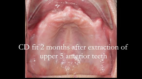 Finlay's Newsletter 62 provision of extractions and metal based complete dentures for Rafique