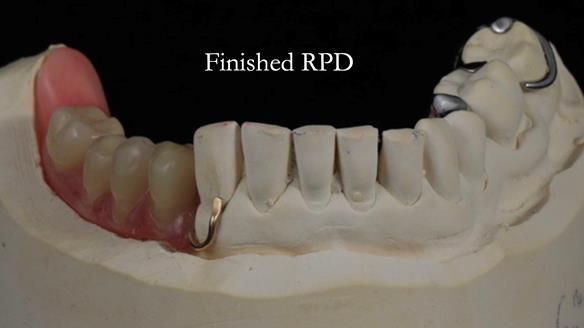 Finlay's Newsletter 61 provision of a lower unilateral free end saddle metal based partial denture for Joyce