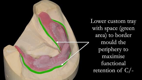 Newsletter 50 Special edition Complete Dentures FULL PROTOCOL