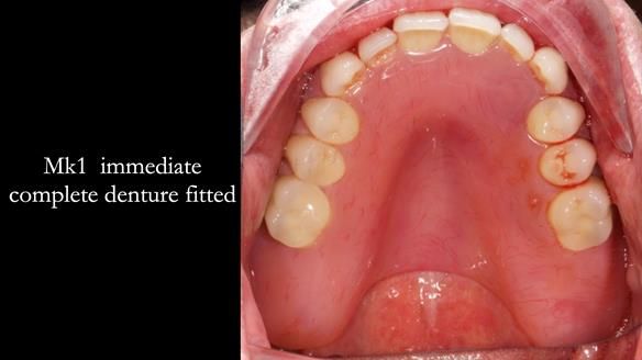 Newsletter 77: Jeremy’s case – immediate complete upper denture