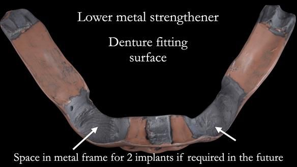 Newsletter 50 Special edition Complete Dentures FULL PROTOCOL