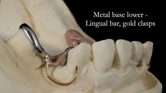 Newsletter 55 Provision of metal based partial dentures for Zephyrine with a repaired cleft lip and palate