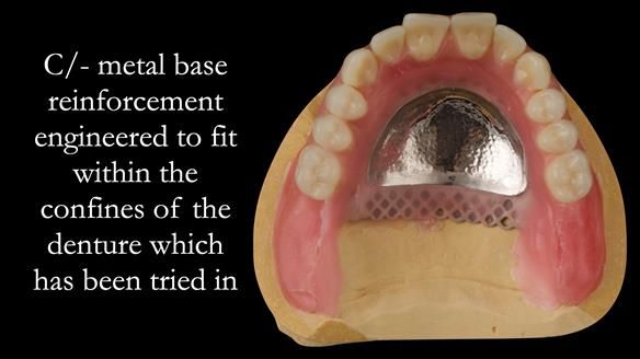 Managing poor implant positioning with complete dentures and Locator attachments - full protocol Newsletter 41