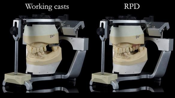 Newsletter 56 showing the making and fitting of a bilateral free end saddle upper removable partial denture (RPD) for patient with pemphigus