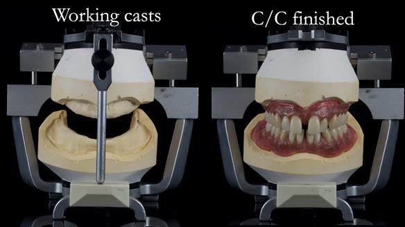 Newsletter 53 showing the making and fitting of ultra life-like dentures for Valena