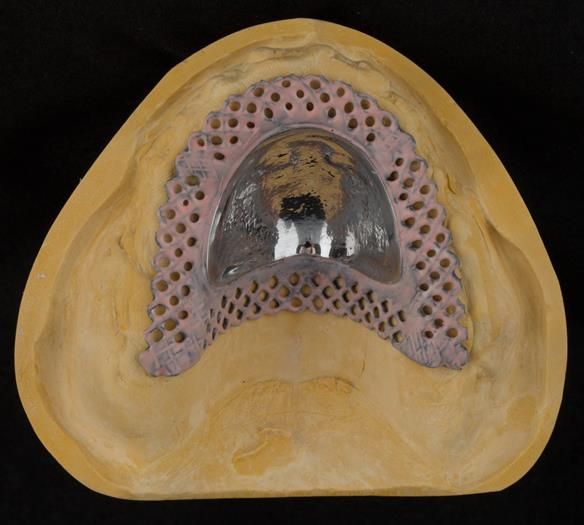 Figure 98 Cobalt chromium base for complete upper denture for increased fracture resistance (Chris Hesketh). This will have an acrylic post dam which I find results in increased suction (retention) and enables relining in the future should this be needed