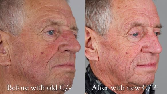 Newsletter 54 case presentation upper complete denture and lower Scandinavian designed hygienic partial denture for David