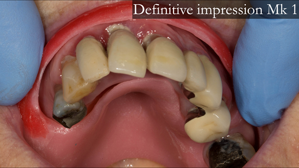 Figure 15 Trying in the under tray - checking the extension - making sure the tray periphery is 2mm short of the depth of the sulcus