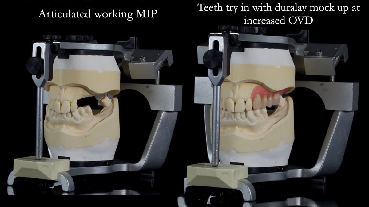 Newsletter 89 – Simon: A Challenging Kennedy Class II Division 1 Upper CoCr Partial Denture with a High Smile Line