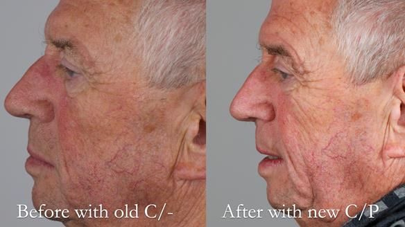 Newsletter 54 case presentation upper complete denture and lower Scandinavian designed hygienic partial denture for David