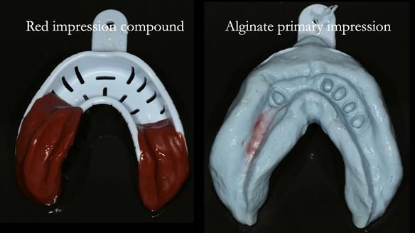 Newsletter 76: Jackie’s case – Telescopic overdenture & precision RPD (the tricky truth!)