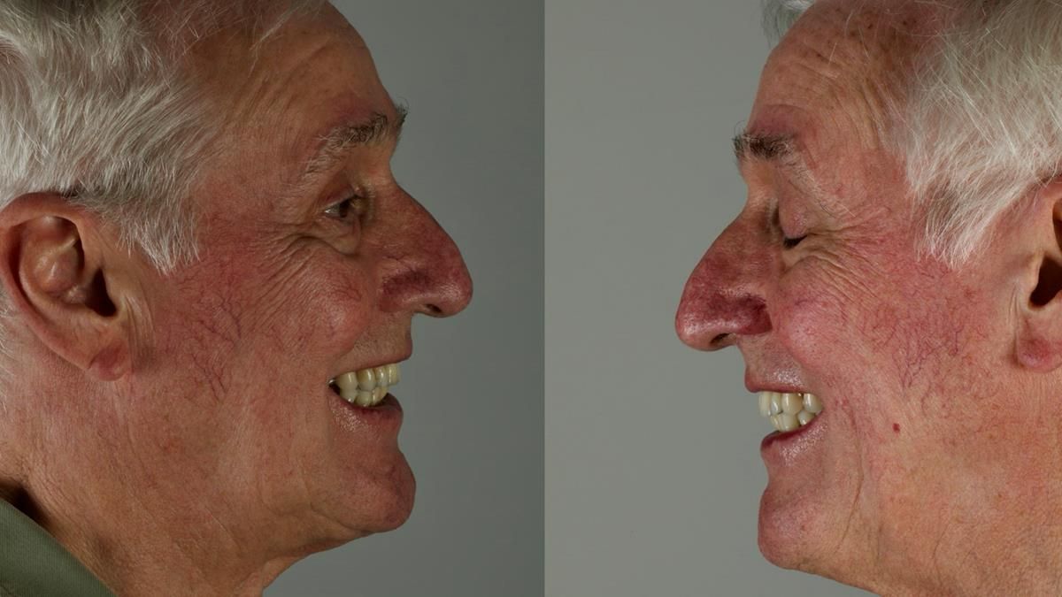 Newsletter 89 – Simon: A Challenging Kennedy Class II Division 1 Upper CoCr Partial Denture with a High Smile Line