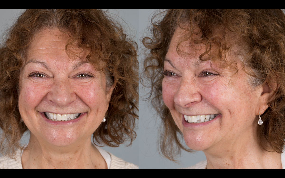 Figure 90 Delighted patient following tooth whitening, replacement crowns and metal based partial dentures.