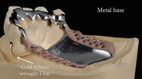 Newsletter 56 showing the making and fitting of a bilateral free end saddle upper removable partial denture (RPD) for patient with pemphigus