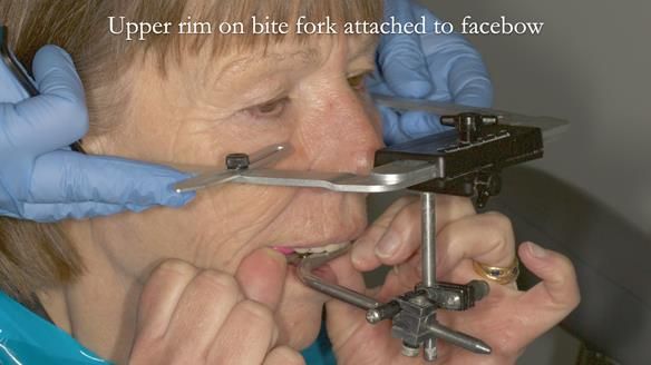 Newsletter 76: Jackie’s case – Telescopic overdenture & precision RPD (the tricky truth!)