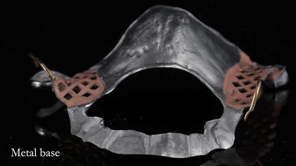 Finlay's Newsletter 60 Sylvia's upper Kennedy Class 2 Mod 1 metal based upper RPD