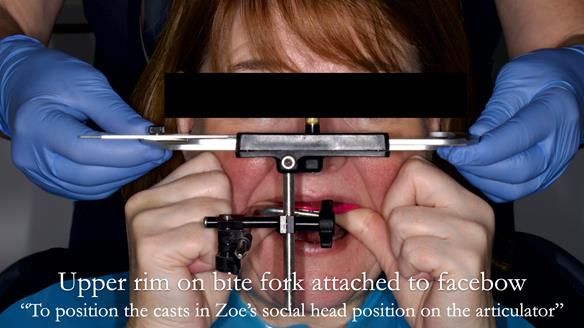 Finlay's Newsletter 58 Gasket upper partial denture for Zoe