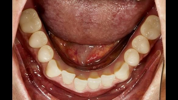 Finished dentures - mimicking Mary’s daughters natural teeth