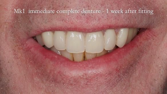 Newsletter 77: Jeremy’s case – immediate complete upper denture