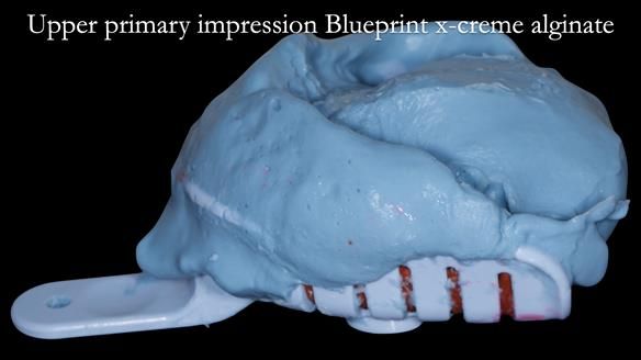 Newsletter 52 Managing Jo’s failing dentition with extractions and Mk 1/Mk 2 complete upper dentures and lower partial dentures FULL PROTOCOL