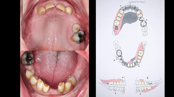 Newsletter 86 Peter the Architect — precision removable partial dentures case study