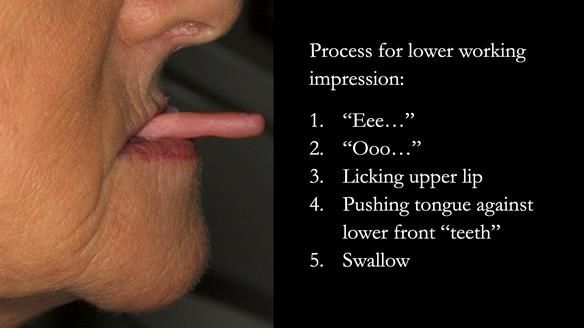 Tray loaded with Impregum. The patient performs all 5 movements twice.
